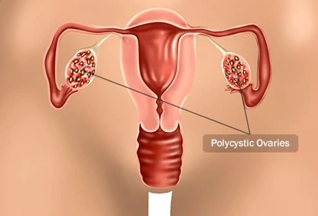 Polycystic Ovary Syndrome
